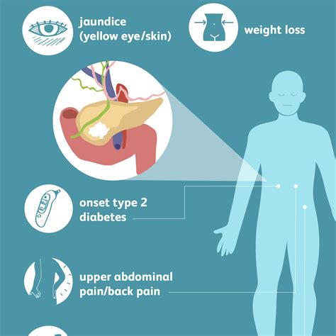 Pancreatic Cancer: Signs, Symptoms, and Complications