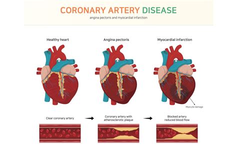 Coronary Artery Disease in Las Cruces