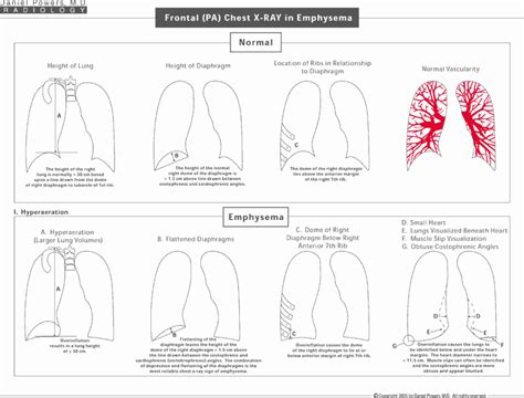 Frontal (PA) Chest X-RAY in Emphysema