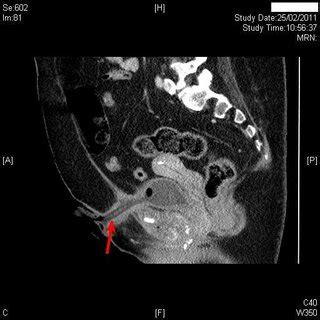 (PDF) Preventable long-term complications of suprapubic cystostomy ...