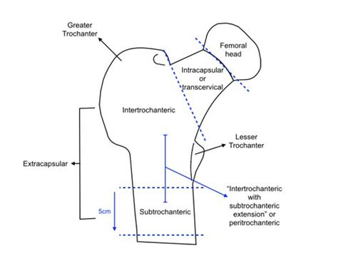 Hip Fracture Classification