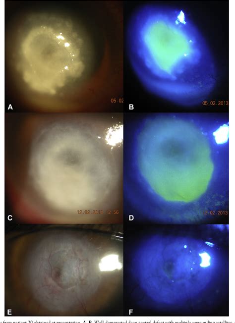 Corneal Perforation | Semantic Scholar