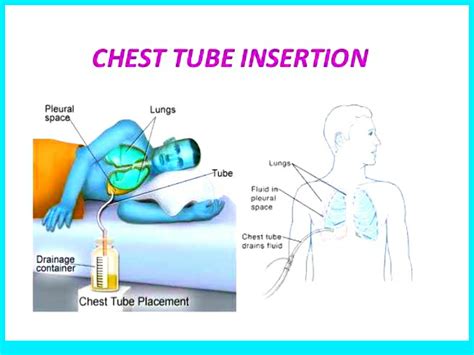 CHEST TUBE INSERTION AND MONITORING - Nurses note help