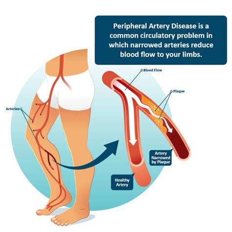 Tulsa Peripheral Artery Disease Treatment - P.A.D. Info - Avoiding ...