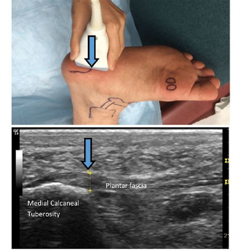 Bedside ultrasound of the plantar heel revealed the insertion of ...