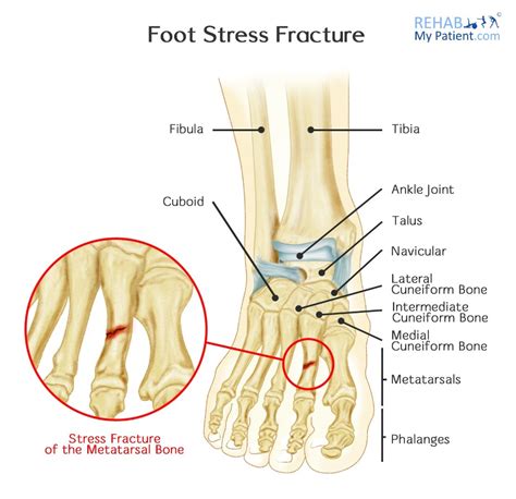 Exercise With Stress Fracture In Foot – Online degrees