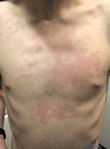 skin-rash-from-mold | Webb Law Group