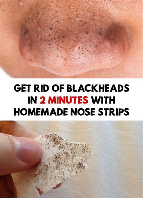 How To Remove Blackheads Without Nose Strips - HOWOTREMVO