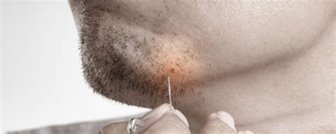 Ingrown Hair – What is it? What Causes it? And How to Treat it