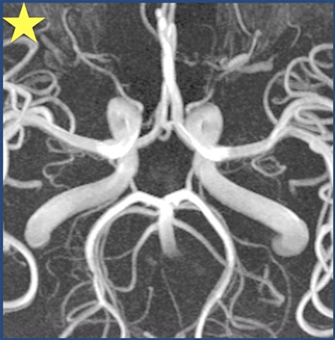 COW MR Angiography (MRA) Labeling Diagram | Quizlet