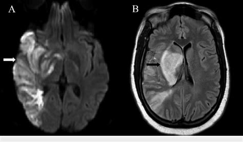 Mri Dwi Stroke