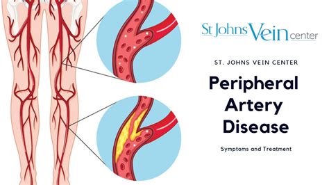 Peripheral Artery Disease Diagnosis and Treatment Options