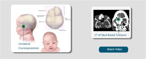 Faciomaxillarysurgery - Craniofacial Surgery