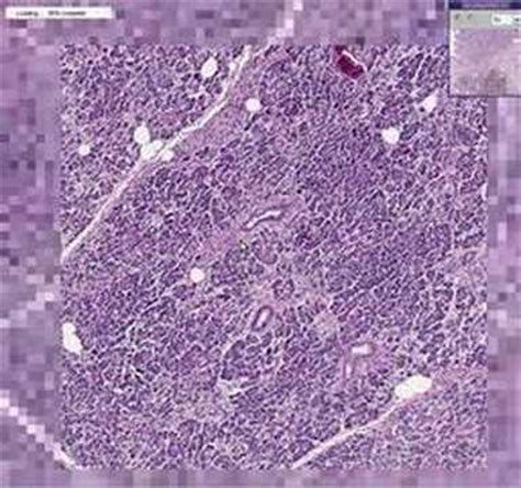 Histopathology Pancreas - - Adenocarcinoma - YouTube