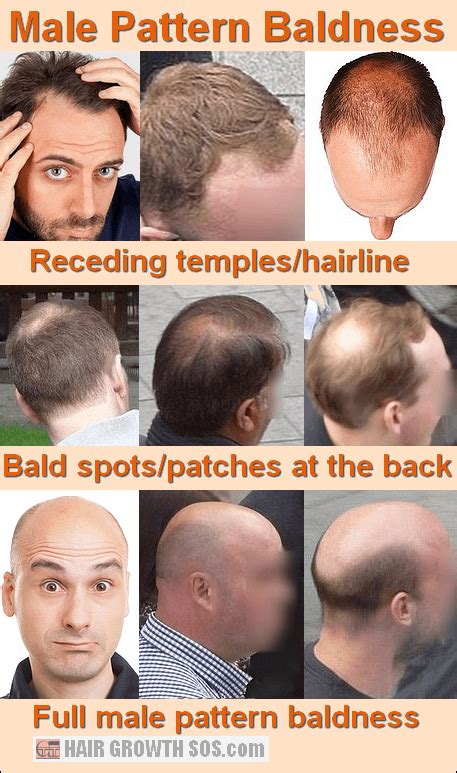 How does male pattern baldness develop? Only skull expansion can ...