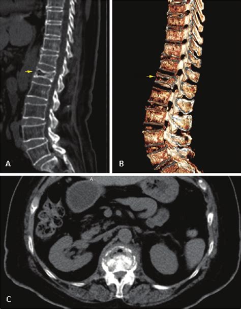 Compression Fracture Ct Scan