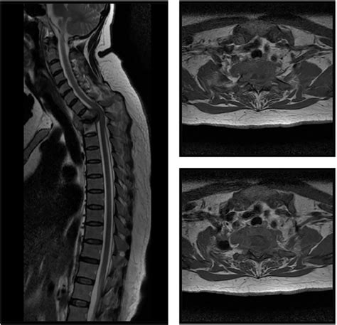 MRI of the thoracic spine. | Download Scientific Diagram