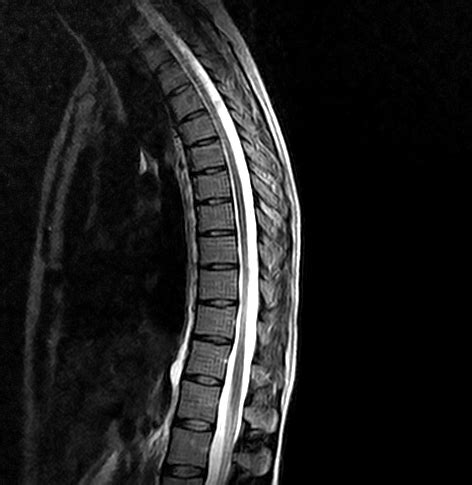 Thoracic Spine MRI scan | Medserena Open MRI