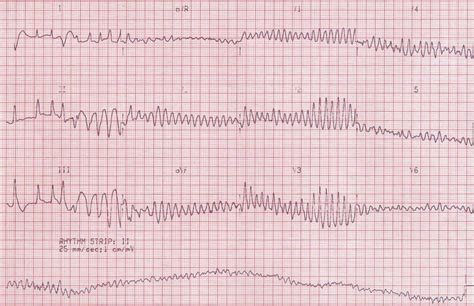 Fine Ventricular Fibrillation