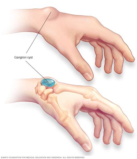 Ganglion cyst - Symptoms and causes - Mayo Clinic