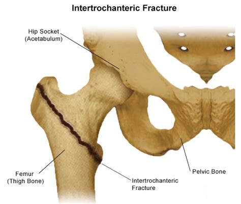 Types of Hip Fractures | Stanford Health Care