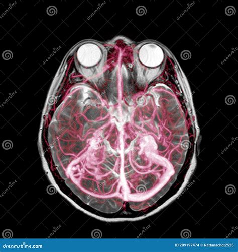 MRA (magnetic Resonance Angiography) of Brain for Stroke Patient ...