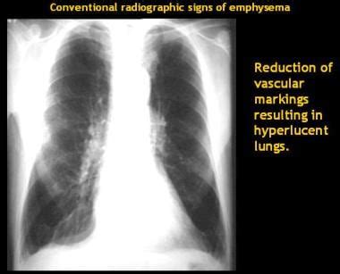 Emphysema Chest X Ray