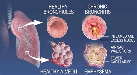 Emphysema Causes, Symptoms, Diagnosis, Treatment