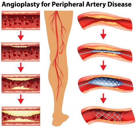 Peripheral Artery Disease Symptoms | Screening & Treatment