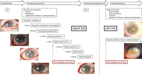 Bilateral Corneal Perforation in a Patient Under Anti-PD1 Th... : Cornea