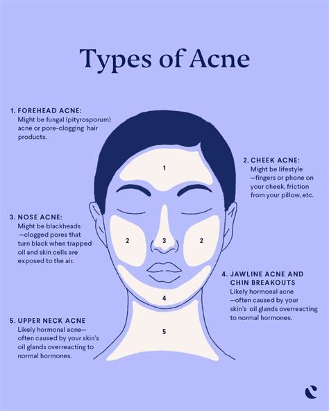 Chin Acne Causes, Pimple Causes, Prevent Breakouts, Prevent Acne ...