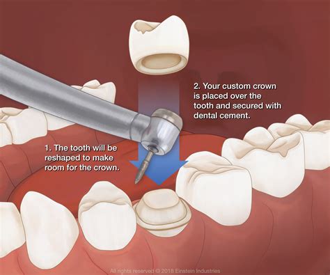 Dental Crowns by Dr. Bruce Wilderman in Philadelphia