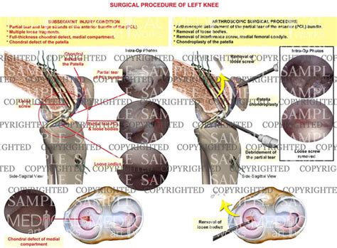 surgical procedure of left knee — Medical Art Works