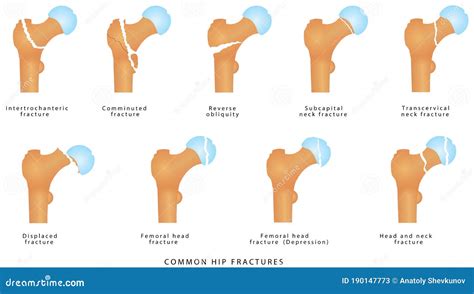 Hip fractures stock vector. Illustration of anatomy - 190147773