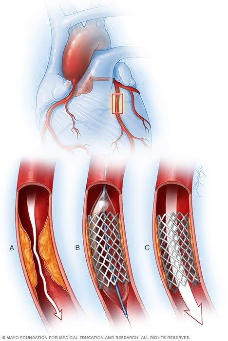 Coronary artery disease - Diagnosis and treatment - Mayo Clinic