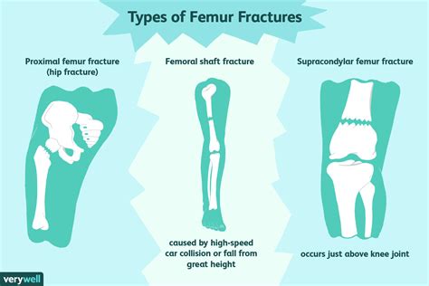 How to Treat a Femur Fracture (Broken Thigh Bone)