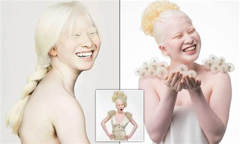 Chinese Albino Children