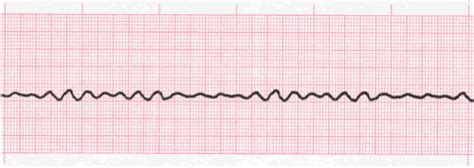 Ventricular Fibrillation - EKG Lesson #315