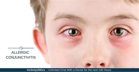 Allergic Conjunctivitis and Its Treatment Options