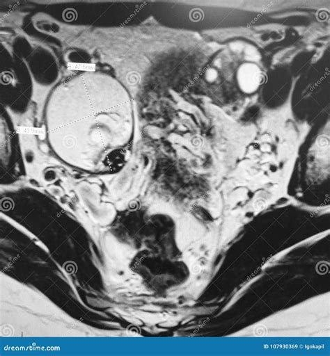 Teratoma Pathology