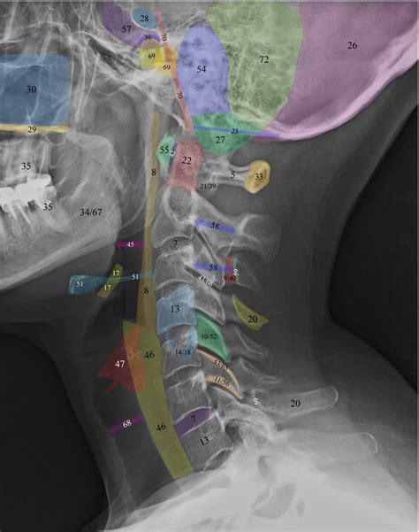 Normal Radiographic Anatomy of the Cervical Spine Radiology Schools ...