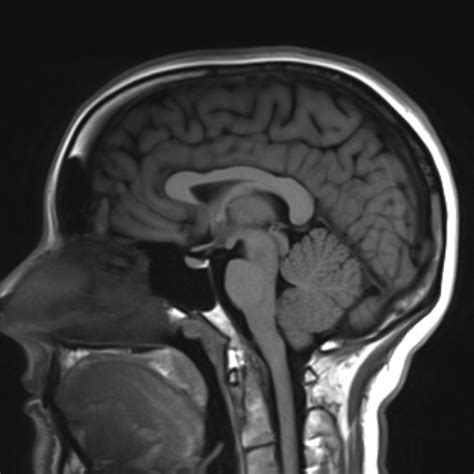 39 Awesome How To Check Mri Brain Report - insectza