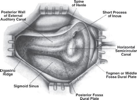 Temporal Bone Surgery | Neupsy Key