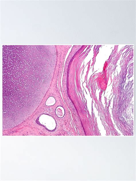 "Teratoma Histology" Poster for Sale by deltoid | Redbubble