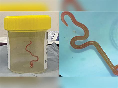 Australian scientists make world-first discovery of parasitic worm in ...