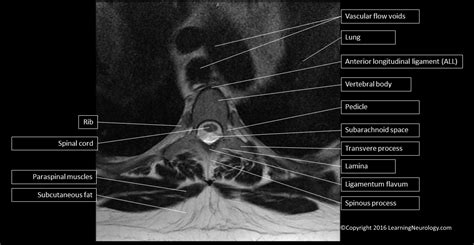 Thoracic Spine Mri Anatomy