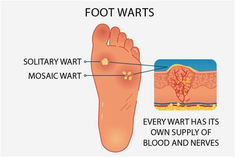 Plantar Warts: Causes, Symptoms and Treatment