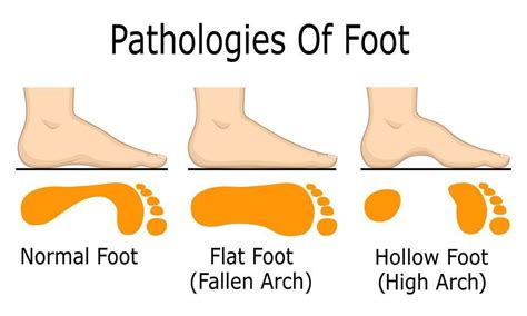 What Causes Flat Feet? | Podiatrist, ABFAS Certified in Foot ...