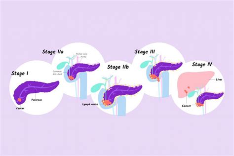 Pancreatic Cancer: Symptoms, Types, Causes & Treatment