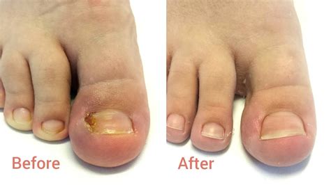 Ingrown Nail Removal - Nail Ftempo